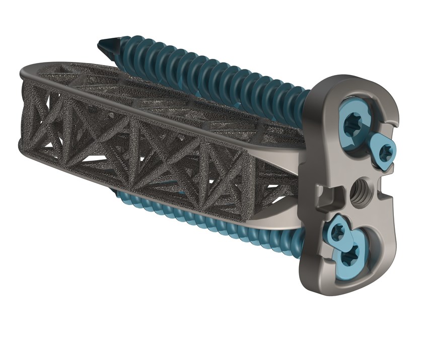 4WEB Medical Launches Hyperlordotic Lateral Implant Portfolio - Vimarsana News