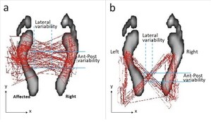 New Parkinson's Procedure Improves Gaits and Back Pain