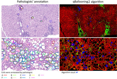 Figure 1: Two examples showing the identification of hepatocyte ballooning by pathologists (left) and qBallooning2 (right). The AI algorithm reading, from a separate drug trial, showing agreement with the study pathologist’s interpretation[1]. Picture Credits: The Complexity of Ballooned Hepatocyte (BH) Identification: Time to Rethink Trial Endpoints for Nonalcoholic Steatohepatitis? by Elizabeth M Brunt, Quentin Anstee, Dean Tai, et. al. Poster presentation, The Liver Meeting (AASLD) 2021.