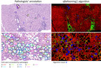 HistoIndex and Global Liver Experts Advance Stain-free AI Quantification of Hepatocyte Ballooning as a Reproducible Approach and Potential Endpoint for NASH Clinical Trials