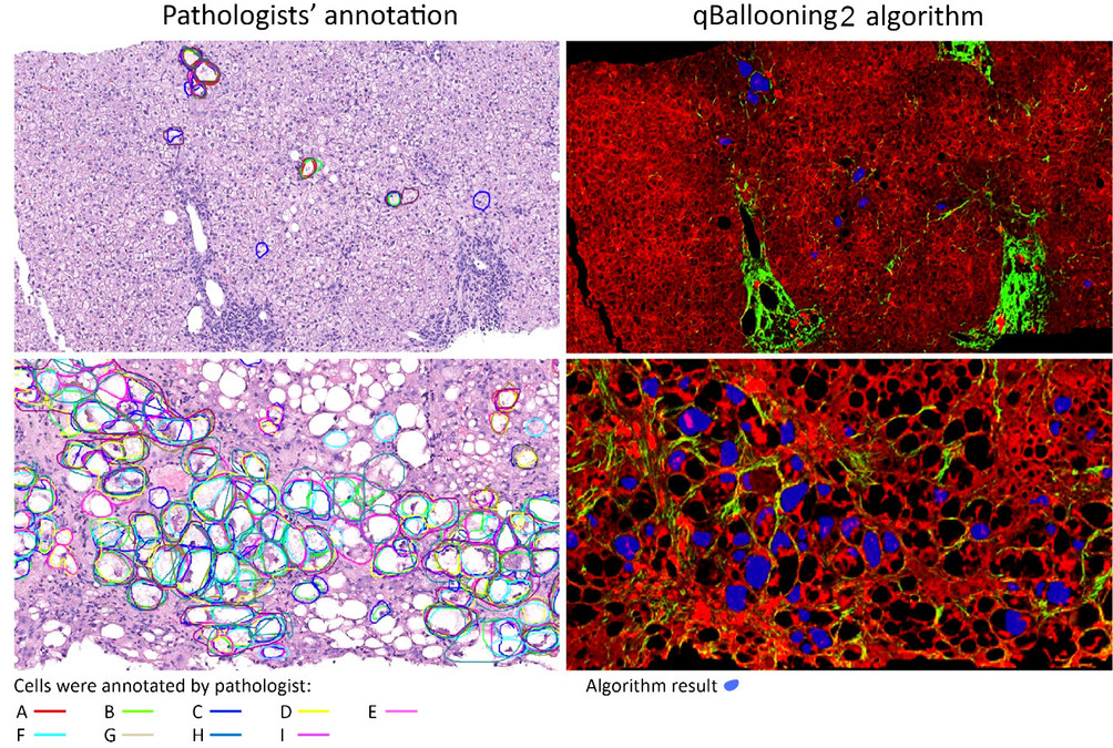 HistoIndex and Global Liver Experts Advance Stain-free AI Quantification of Hepatocyte Ballooning as a Reproducible Approach and Potential Endpoint for NASH Clinical Trials - Vimarsana News