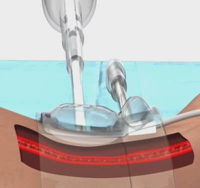 A cross-section of the PH Band System (Radial Band, Doppler Probe; Doppler Unit not shown)