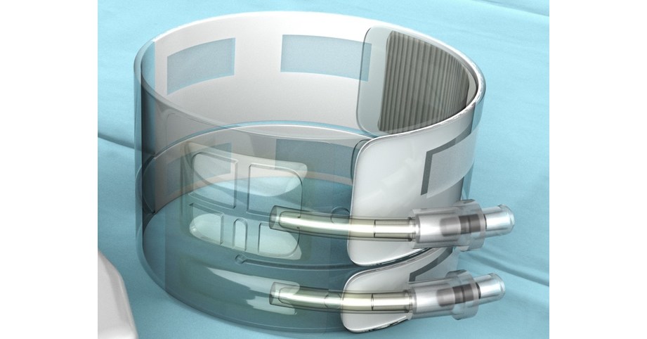 Medical Ingenuities Conducts First Commercial Cases with Transformational Radial Hemostasis Band System to Achieve Patent Hemostasis