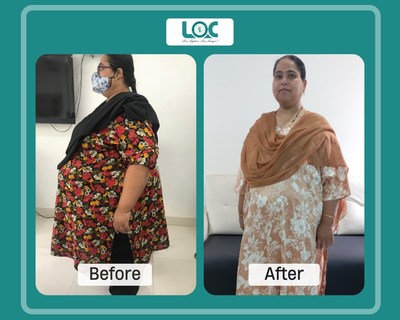 Mrs Khan before and after weight loss treatment at Laparo Obeso Centre