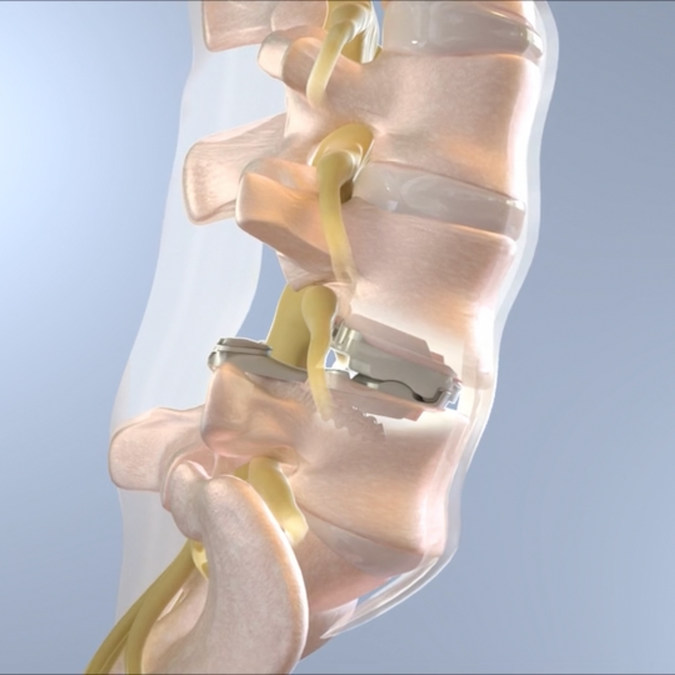 3Spine, Inc. Raises $33M in Private Series C Round - Vimarsana News