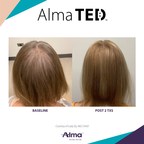 ALMA Treatment Result