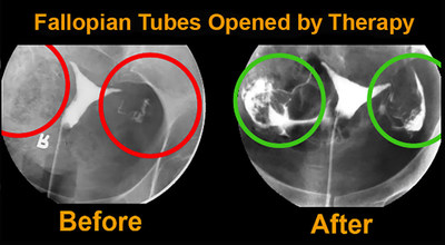 Medical Massage Opens Fallopian Tubes in 143 Infertile Women; 80 Become Pregnant Naturally