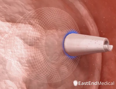 SafeCross System Crossing the Atrial Septum Using the RF Puncture Dilator