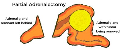 Preliminary clinical data from the Carling Adrenal Center suggest that the use of a human amniotic membrane allograph on the adrenal gland remnant following partial adrenal surgery leads to faster recovery of normal adrenal gland function. Rather than removing the entire adrenal gland—which has been standard of care for decades—a portion of the adrenal gland is able to be salvaged with amniotic membrane placed upon the remnant as a biologic covering.
