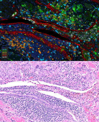 Whole slide digital scanning of 6-marker panel multiplex IF image and HE stained image of lung adenocarcinoma