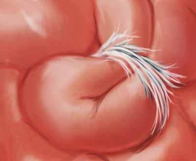 Adhesions can kink the intestine like a garden hose, causing a small bowel obstruction. A total obstruction is 100% fatal unless it is cleared by surgery - or Clear Passage's recently investigated hands-on therapy.