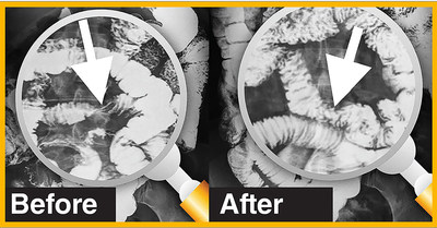 This set of "before and after" images reveals the inside of an intestine (shown in white.) Initially, the bowel was squeezed like an hourglass, preventing the passage of food. Due to the severity, the surgeon scheduled the patient for emergency surgery. Instead, the patient chose to undergo the recently investigated Clear Passage® therapy. After therapy alone, the bowel returned to normal size and structure. Observing the new x-rays, the surgeon canceled the surgery as "no longer required."