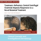 Treatment-Refractory Central Centrifugal Cicatricial Alopecia...