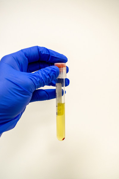 PRP is isolated by a high-speed centrifuge and injected back into the affected joint.