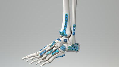 Medline UNITE Foot & Ankle implant.