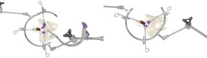 TeDan Surgical Innovations Redefines Anterior to the Psoas Access with the Release of the Phantom UL ATP Surgical Access System