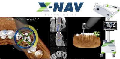 X-Guide Dynamic Surgical Navigation for Minimally Invasive Endodontic Access