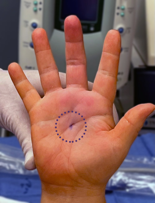 Dr. Richard Schaefer of SSM Health in Fond du Lac, Wis., shows the small incision of his patient's hand immediately after a trigger finger release with Sonex Health's UltraGuideTFR and real-time ultrasound guidance.