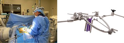 TeDan Surgical Innovations Reimagines Anterior to the Psoas Access 