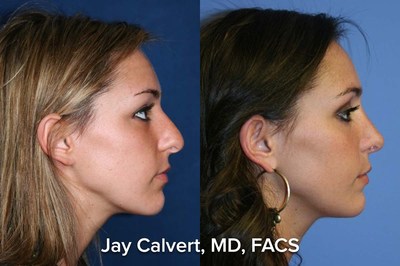 Primary rhinoplasty by Dr Jay Calvert.  In this case, the nose was convex at the bridge and had bulbous alar cartilages.