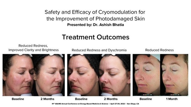 Safety and Efficacy of Cryomodulation for the Improvement of Photodamaged Skin. Presented by: Dr. Ashish Bhatia.