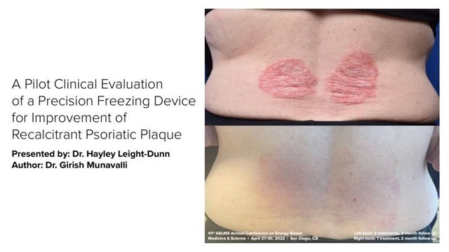 A Pilot Clinical Evaluation of a Precision Freezing Device for Improvement of Recalcitrant Psoriatic Plaque. Presented by: Dr. Hayley Leight-Dunn. Author: Dr. Girish Munavalli.