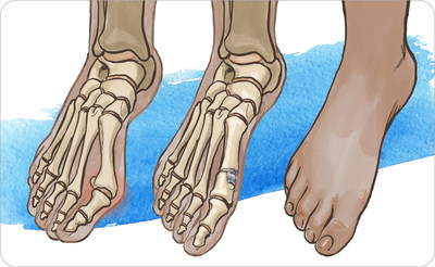 At left, the bunion before surgery. Middle image shows the completed, minimally invasive Active Bunion surgery. At right, the healed foot with an ~1” external scar.