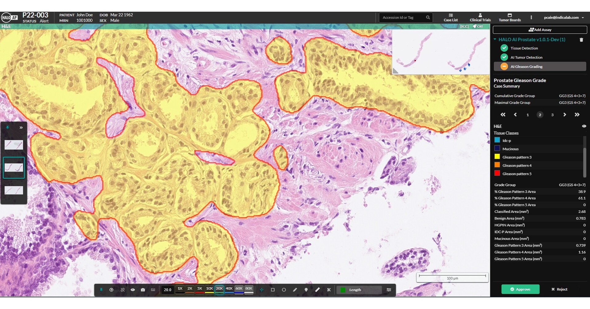 Indica Labs achieves CEIVD certification for AIbased Prostate Cancer Detection and Gleason