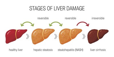 Stages of Liver Disease (CNW Group/Fatty Liver Alliance)