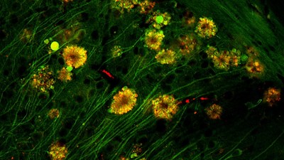 Three images, as seen by fluorescent microscopy, show flower-like formations (at decreasing resolution) of autophagic vacuoles in neurons of Alzheimer’s disease mouse. Courtesy of Springer-Nature Publishing.