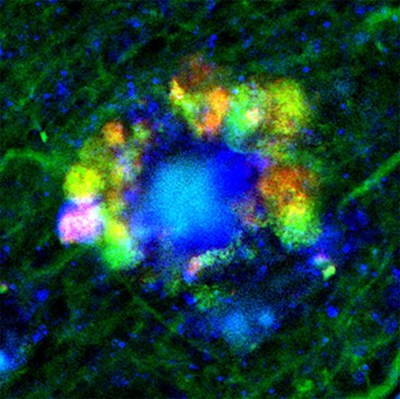 Three images, as seen by fluorescent microscopy, show flower-like formations (at decreasing resolution) of autophagic vacuoles in neurons of Alzheimer’s disease mouse. Courtesy of Springer-Nature Publishing.