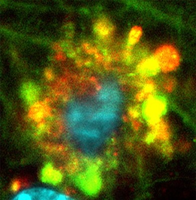 Three images, as seen by fluorescent microscopy, show flower-like formations (at decreasing resolution) of autophagic vacuoles in neurons of Alzheimer’s disease mouse. Courtesy of Springer-Nature Publishing.