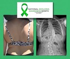 ** June is Scoliosis Awareness Month **