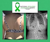 https://mma.prnewswire.com/media/1829880/2022_June_is_National_Scoliosis_Awareness_Month__1.jpg?w=200