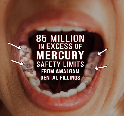 Daily mercury vapor doses from amalgam fillings were found to be in excess of  California’s Environmental Protection Agency (EPA) safety limit for about 86 million (54.3%) adults