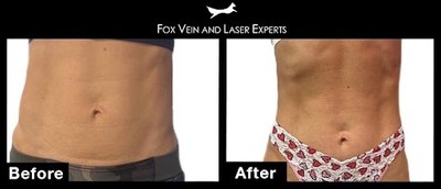 Fox Vein & Laser Experts with a Fort Lauderdale vein clinic and Miami vein clinic, offers patients the award-winning PHYSIQ body contouring therapy from Cartessa. This Before & After image shows the incredible effect of PHYSIQ on a woman's abdomen creating new musculature definition.