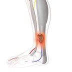 Sky Medical Technology: Speeding recovery from venous leg ulcers can help reduce potentially complex side effects