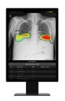 Lunit AI Solution for Radiology Receives Health Canada Nod for Commercial Use