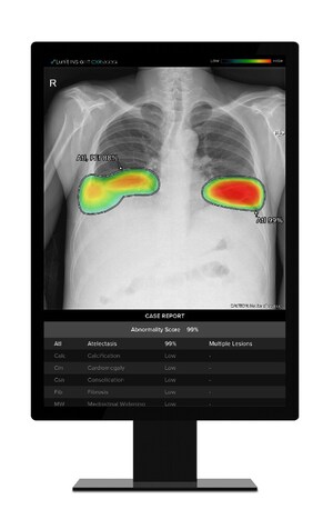 Lunit AI Solution for Radiology Receives Health Canada Nod for Commercial Use
