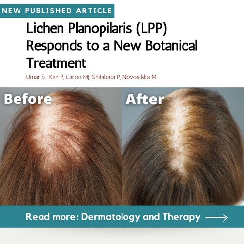 Lichen Planopilaris Responsive to a Natural Botanical Treatment