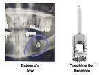 Deposition Reveals That Texas Oral Surgeon Who Left Metal Drill Bit Inside Woman's Jaw Kept It Secret and Neglected to Give Corrective Care
