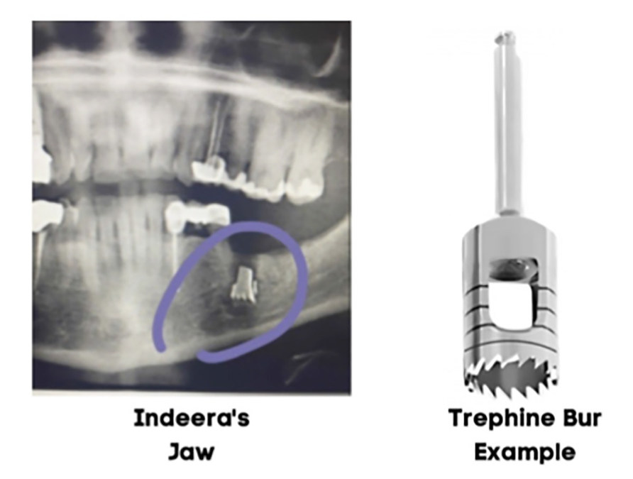 Deposition Reveals That Texas Oral Surgeon Who Left Metal Drill Bit Inside Woman's Jaw Kept It Secret and Neglected to Give Corrective Care - Vimarsana News