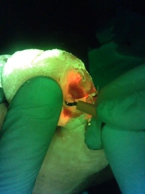 Targeted debridement of wound using the MolecuLight point-of-care imaging device for detection of elevated bacterial burden