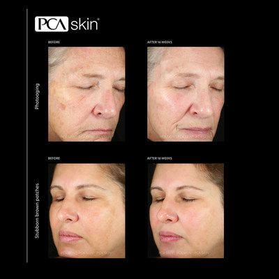 Get Even with Uneven Skin, PCA SKIN® Introduces New Pigment Gel® Pro