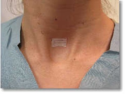 This photo shows a patient following her minimally invasive parathyroid surgery. The incision made is very small, only requiring a band-aid which will come off in under a week. There are no stitches to take out.