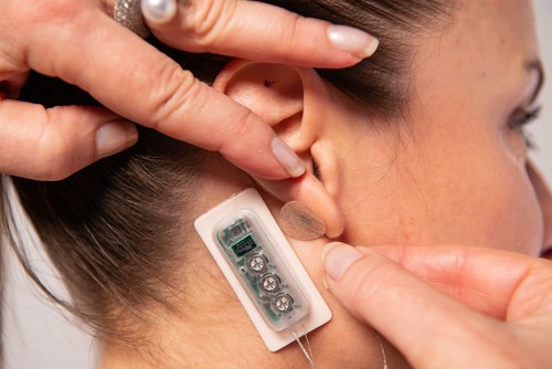 The First Relief percutaneous neurostimulation device can be used to treat pain related to diabetic neuropathy. It is applied behind the ear and delivers continuous pulses of a low-level electrical current over several days.