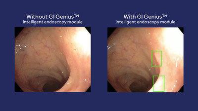Colonoscopy with and without Medtronic GI Genius™ intelligent endoscopy module