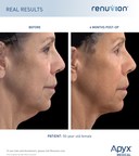 RENUVION® CLEARED BY FDA FOR NECK LAXITY PROCEDURES OFFERING PATIENTS A MINIMALLY INVASIVE OPTION TO ELIMINATE SAGGING NECK