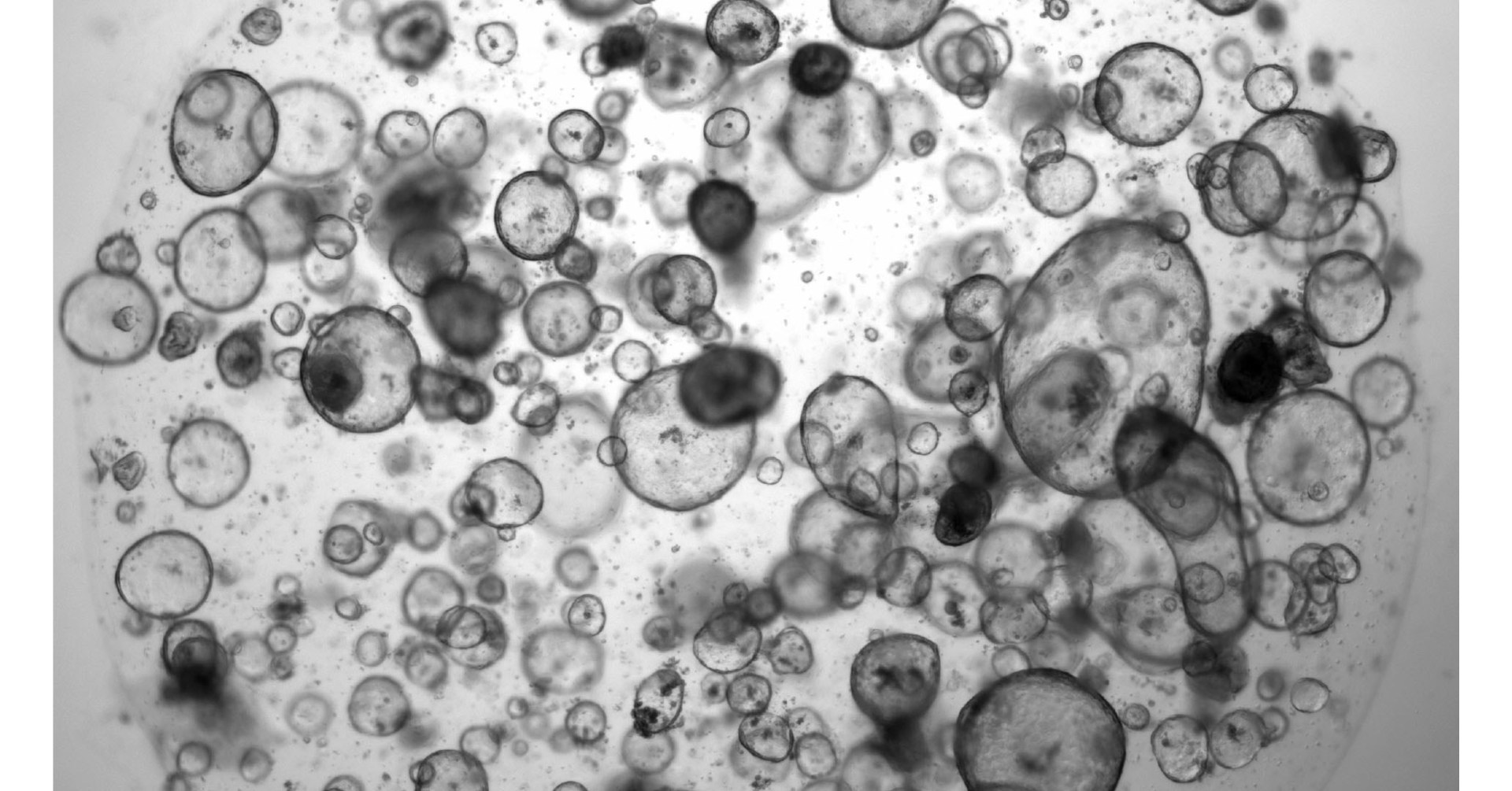 How organoids can guide pancreatic cancer therapy