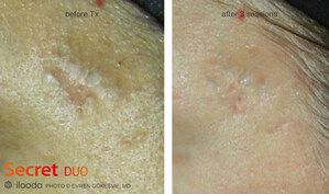 ilooda's Medical Device Wins FDA Approval for Treating Scars After Monkeypox